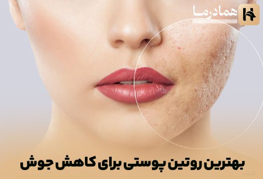 بهترین روتین پوستی برای کاهش جوش