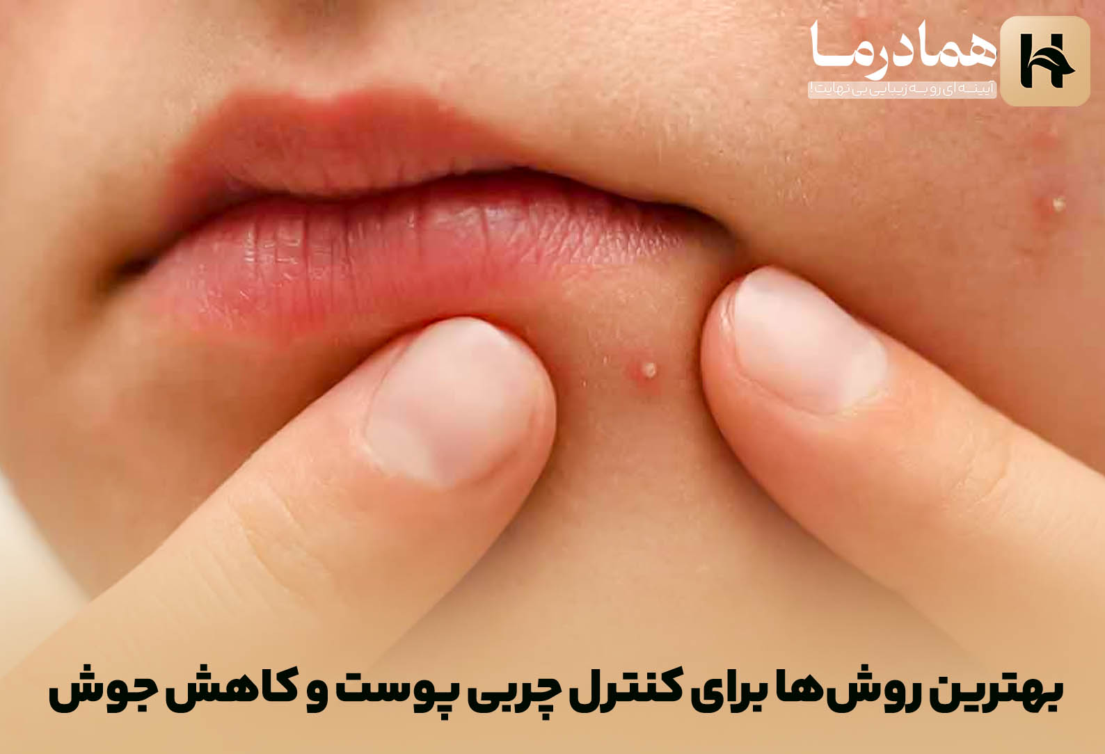 بهترین روش‌ها برای کنترل چربی پوست و کاهش جوش