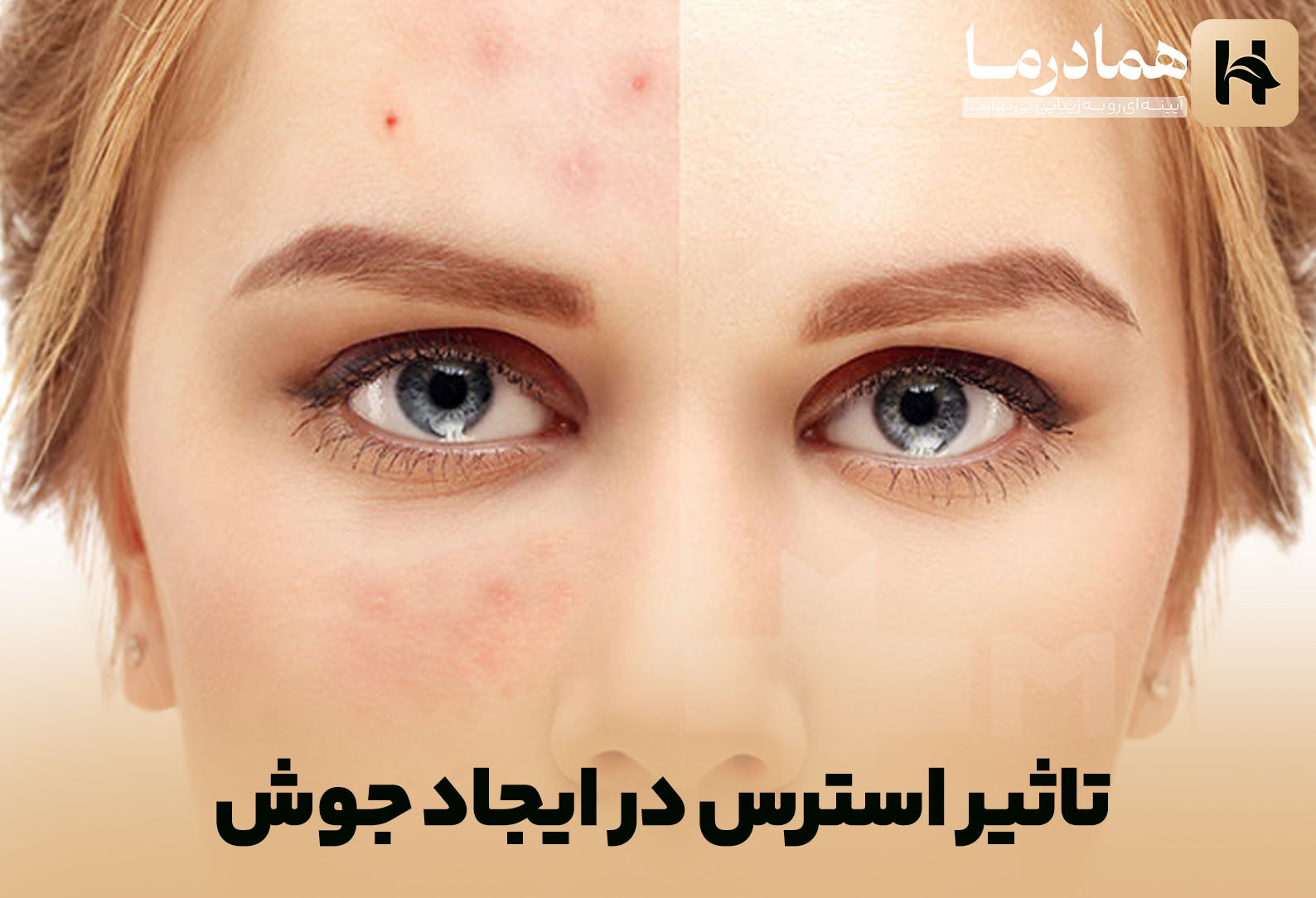 تاثیر استرس در ایجاد جوش