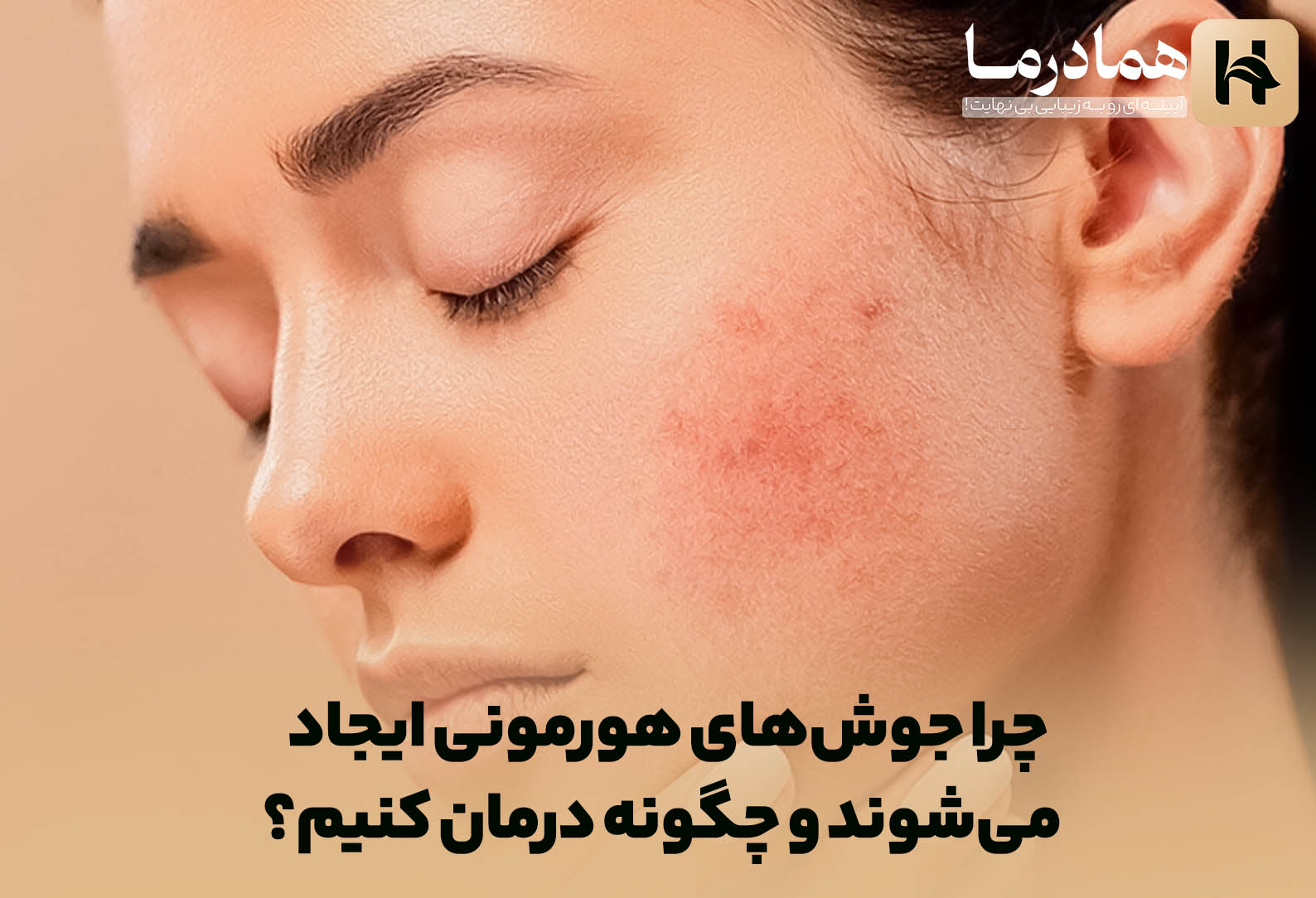 چه موقع جوش‌های هورمونی بیشتر می‌شوند؟